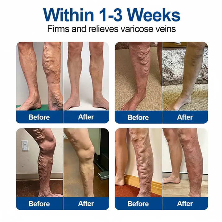 🏆🏆🇬🇧👨‍⚕️✅Natravor® VeinEase Microneedle Care Patch⚡Instant Relief, Long-Term Results